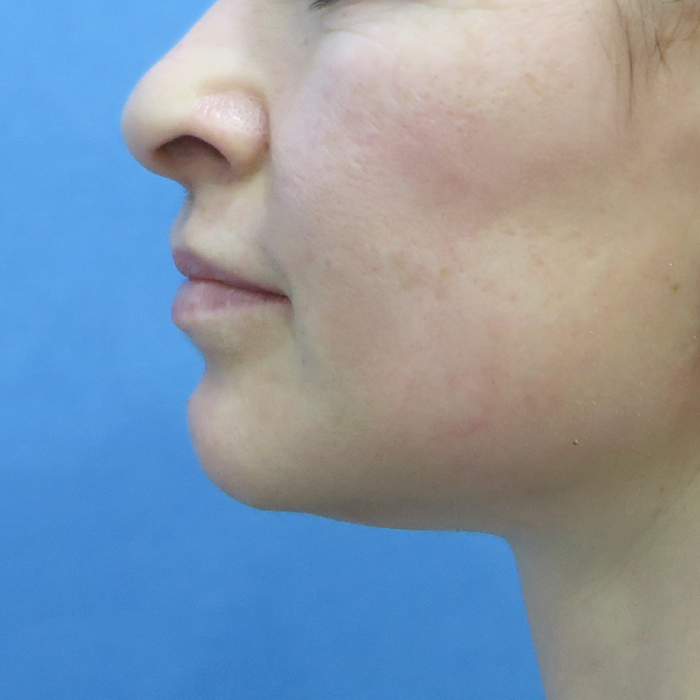 Before and After: Mini Facelift and Tri... Thumbnail