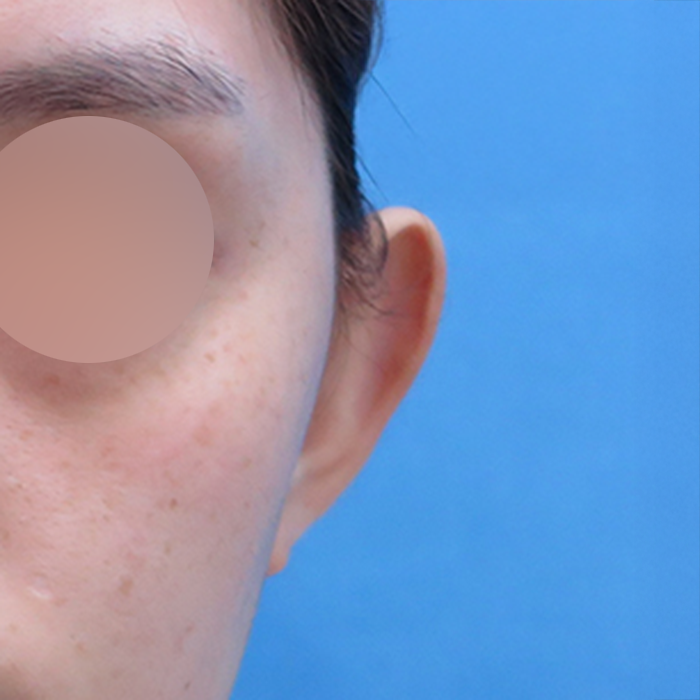 Ảnh Trước Và Sau Phẫu Thuật Chỉnh Sửa Tai Vểnh Của Khách Hàng  Thumbnail
