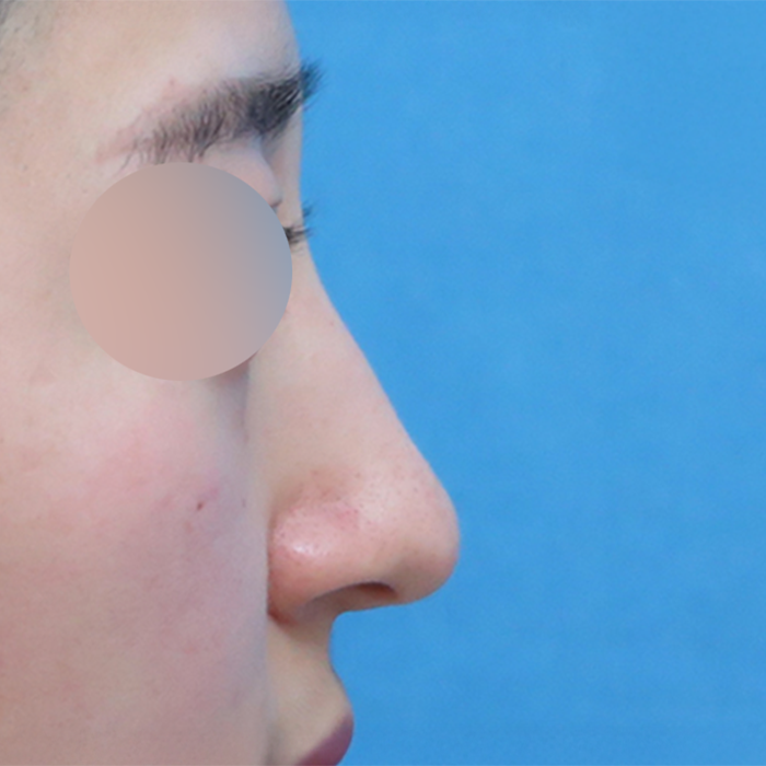 Phẫu Thuật Chỉnh Sửa Mũi Gồ Và Đầu Mũi Của Khách Hàng Độ Tuổi 20 Thumbnail